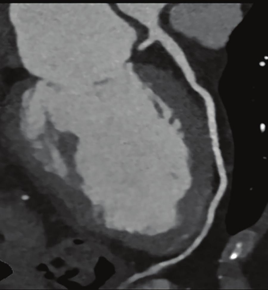 A symptomatic but low-risk male patient with atypical chest pain was scanned on the IQon Spectral CT for a quick exclusion of coronary artery disease (CAD).