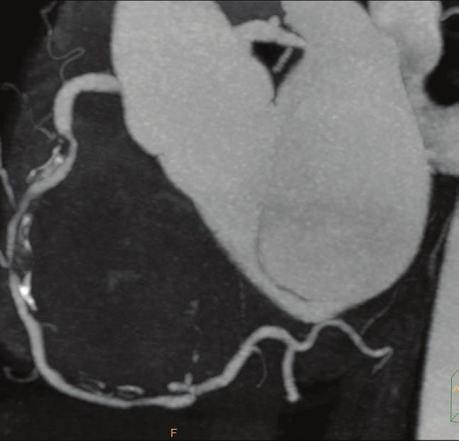 Case study 2 Kumamoto Chuo Hospital Kumamoto, Japan Figure 2a: RCA, Conventional Patient was admitted to the emergency department and referred to CT for an evaluation of chest pain.