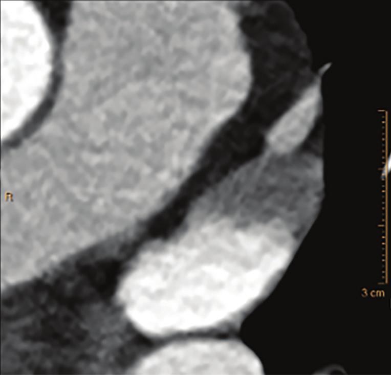 Case study 6 University Hospitals Cleveland, Ohio, USA A middle-aged male with atrial fibrillation was scanned on the IQon Spectral CT for the assessment of the left atrial and the pulmonary vein