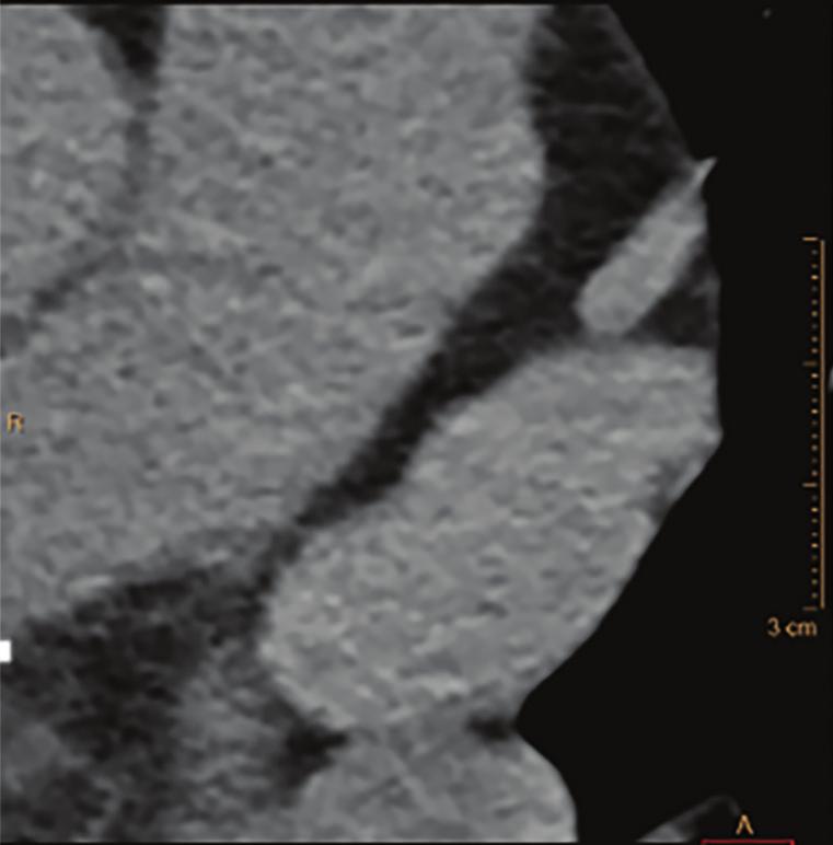 The conventional reconstruction of the arterial phase showed an area of low attenuation in the left atrial appendage, typically associated with either a clot or an area with slow flow (Figure 6a).
