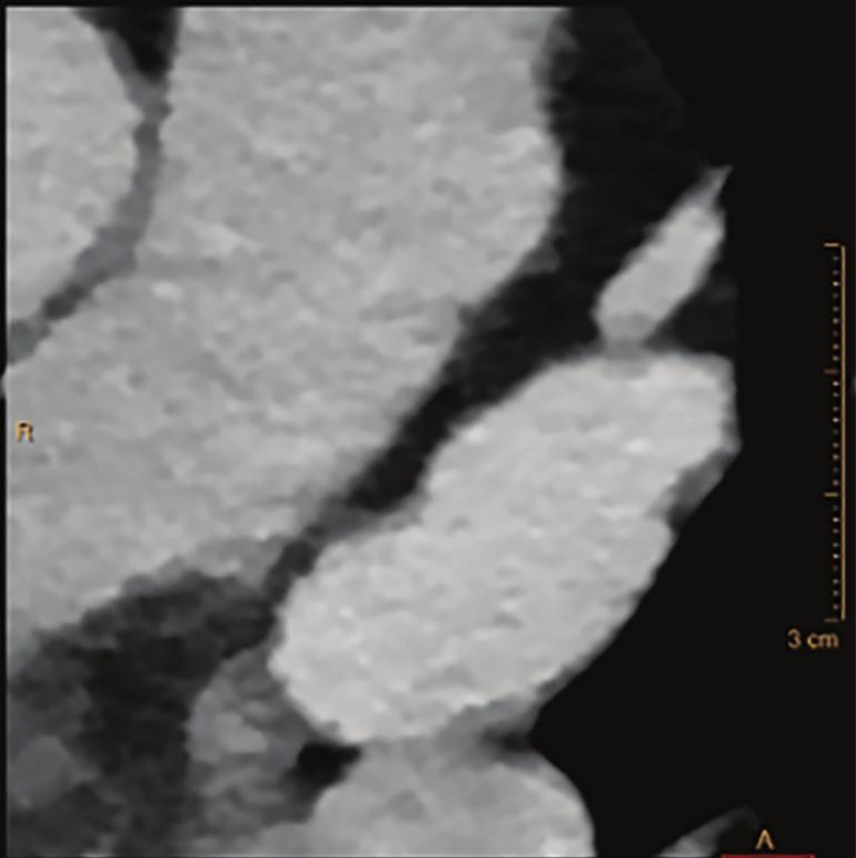 The conventional reconstruction from this delayed scan appeared to show filling of the atrial appendage, but could not be confirmed by the clinician because of the lack of contrast enhancement