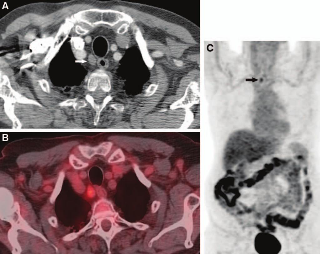Journal of Thoracic Oncology Volume 9, Number 8, August 2014 Clinical Staging of Patients with Early Esophageal Cancer FIGURE 1. (A) 78-year-old man with a distal T1a esophageal malignancy.