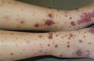11 A 21 year old man presents with a 6-week history rash to his lower legs. It is palpable but non-tender. On systems review, he is well in himself.