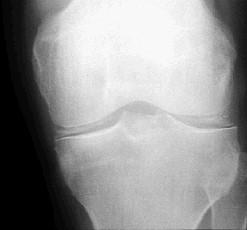 13 A 41 year old man with haemochromatosis presents with pain and swelling in his right knee. You request an x-ray. The report reads Loss of joint space and chondrocalcinosis present.
