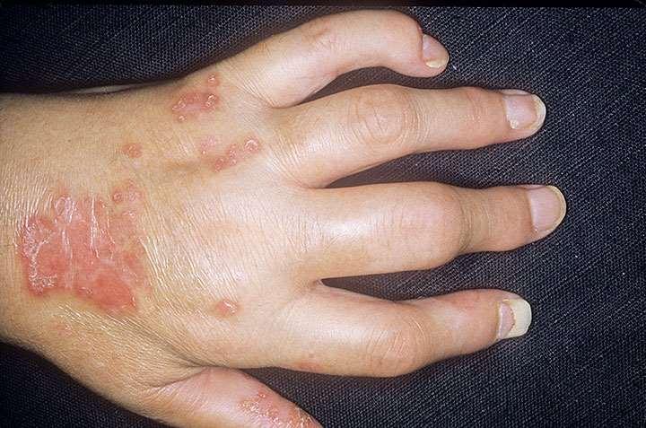 15 A 30 year old lady developed a polyarthritis 5 years ago. What is the diagnosis?