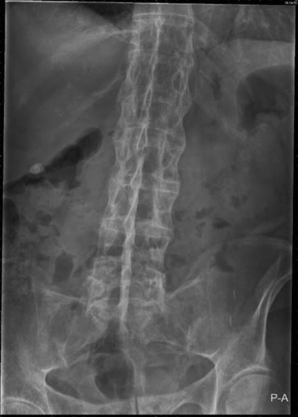 17 A 48 year old man has a 20 year history of back pain. He has had some improvement with naproxen.