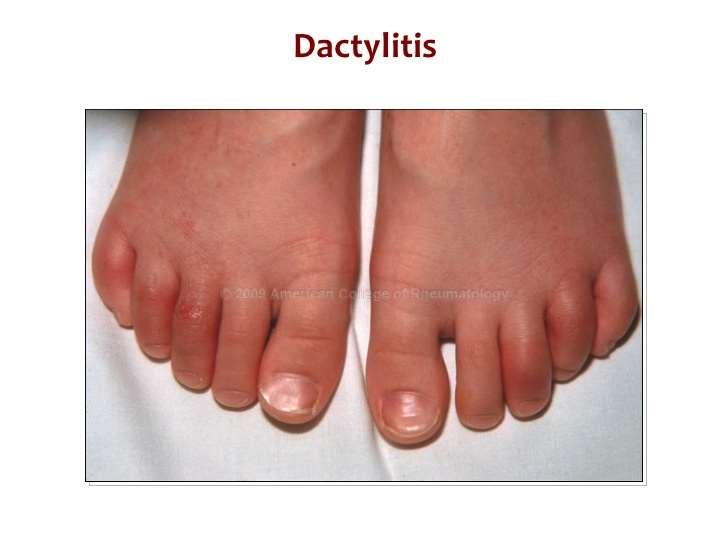 18 What is the most common cause of dactylitis?