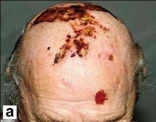 25 An 80 year old man treated for 6 months for polymyalgia rheumatica presents with headache and fever. He has developed painful skin changes to his scalp over the past 3 days.