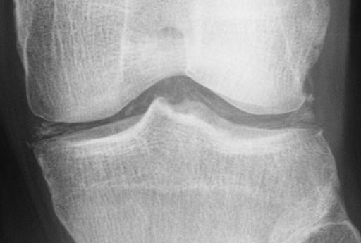 3 A 45 year-old man has had arthritis affecting his left knee, ankles and hands and wrists for 5