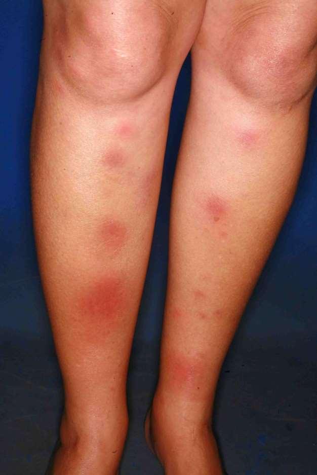 9 A 32 year old lady presents with a 7 day history of pain and swelling to her ankles and a rash to her shins. What is the most likely outcome?