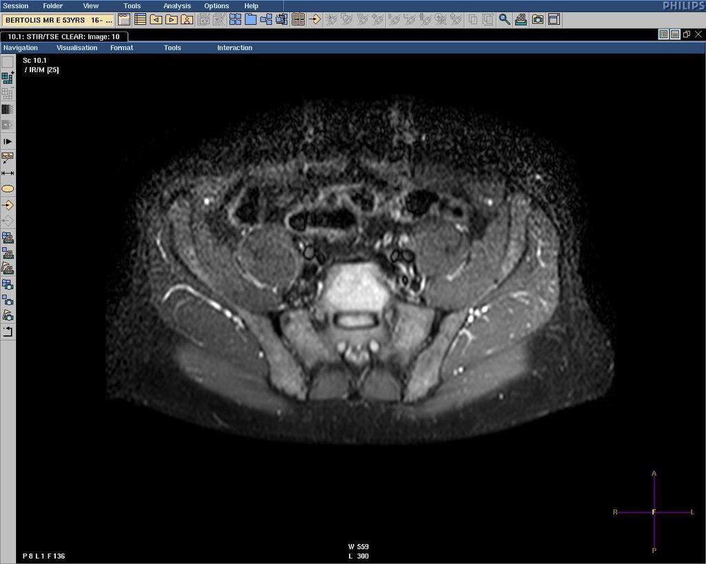 Axial T2 weighted MRI with