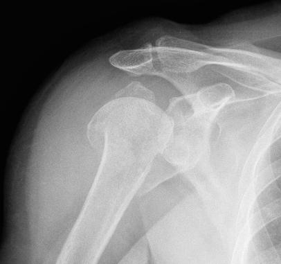 Associated Injuries geriatric patients look for other osteoporotic fractures shoulder wrist