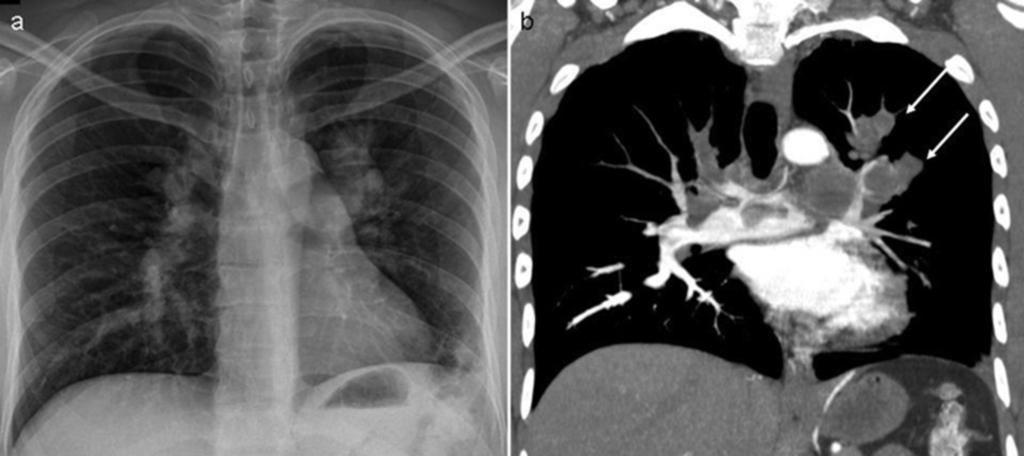 Images for this section: Fig. 1: Chest X-ray (a) showed marked ectasia of the pulmonary arteries.
