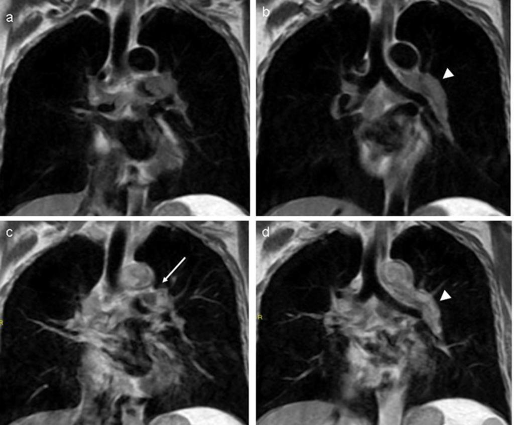 Fig. 5: Cardiac-gated MRI in a patient with bilateral PAS.