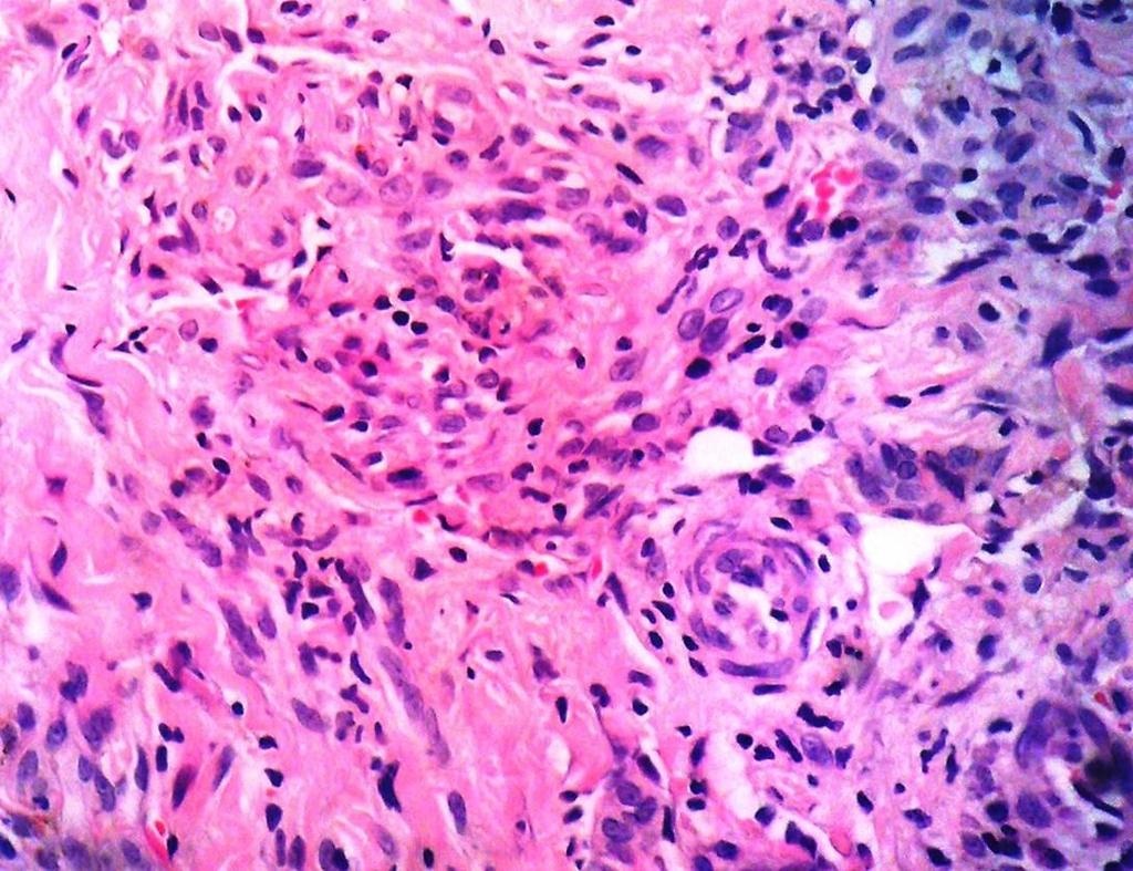 The tumor is composed of proliferating spindle cells