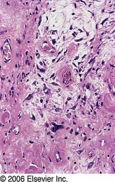 High grade myxofibrosarcoma Immunopathology Positive: CD 117, 34, 68, desmin Negative: AE1/AE3, EMA, HMB45, S100, Actin Malignant stromal