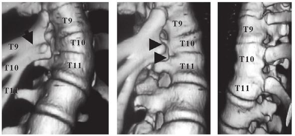 In all cases in group AL, the vertebral bodies paired with posterior components with