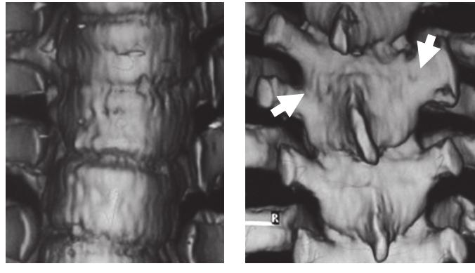 10) and one had a discordant anomaly in which the vertebral bodies made another pair with posterior components