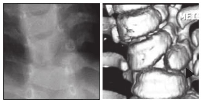 Three-Dimensional CT Analysis of Congenital Scoliosis and Kyphosis: A New Classification 267 Fig. 17. Images for group P.
