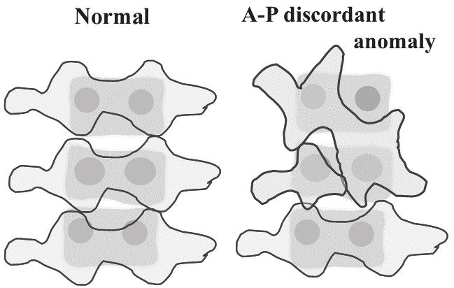 Three-Dimensional CT Analysis of Congenital Scoliosis and Kyphosis: A New Classification 269 anomaly, it is possible for AP discordant anomaly with hemilamina to occur with or without posterior
