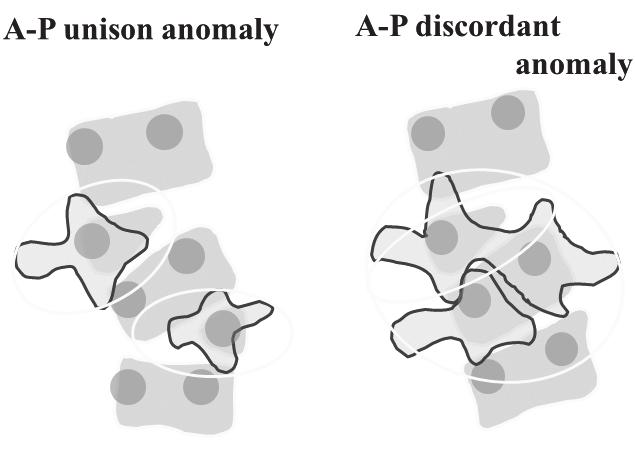When anterior segmentation failure is present, AP discordant anomaly may occur (Fig. 19C).