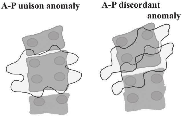 270 CT Scanning Techniques and Applications C D Fig. 19. Scheme of AP discordant anomaly.