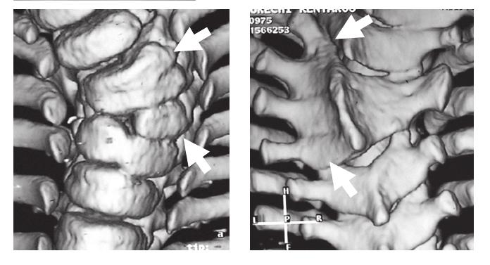 In this chapter, we introduce the utility of 3DCT and describe variations of congenital deformity detected by 3DCT, based on Winter s classification of deformity. Fig. 1.