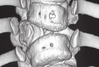 A plain radiograph shows a hemivertebra (white arrow), but does not show the posterior