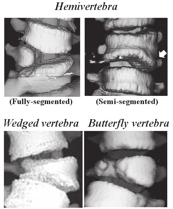 Three-Dimensional CT Analysis of Congenital Scoliosis and