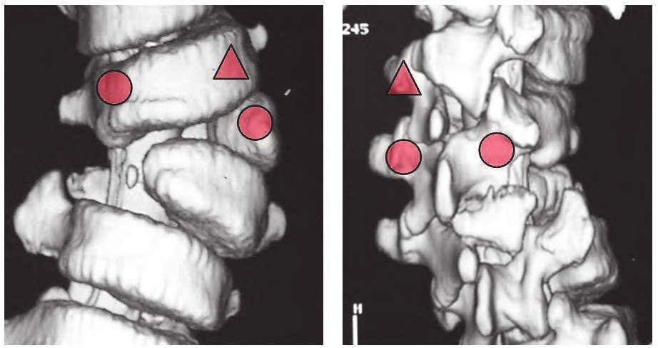 256 CT Scanning Techniques and Applications Anterior component Hemivertebra (hemi-pedicle) Butterfly vertebra (bipedicle) Lateral wedged vertebra (bipedicle) Posterior component Fully segmented