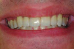 Figure 5 Approximately 2 mm of free gingiva were removed from the facial aspect of the maxillary right lateral incisor to correct the cervicoincisal height of the tooth.