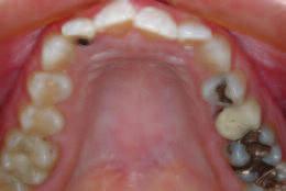 For a select group of these patients with minor tooth malposition such as spacing (diastemas), crowding (mesial and/or distal overlapping), and facial-lingual arch form displacement esthetic and