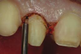However, the patient must understand that correction of these malpositions will require a more aggressive preparation of the teeth involved to align the arch form.