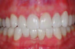 One key to good results is having adequate interradicular space for development of a healthy gingival papilla that is easily cleansable by the patient.