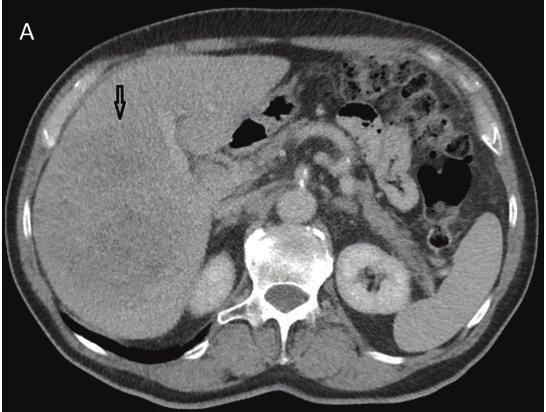 2 Case Reports in Surgery (a) Figure 2: The liver in a patient with large HCC on the right side at the beginning of stage 2 operation; a plastic bag is placed around the right liver half and segment