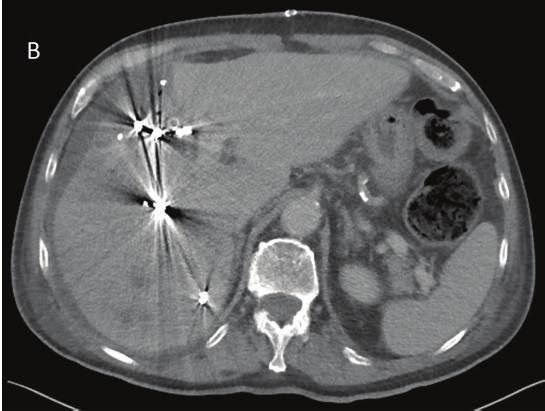 of the mass were consistent with a hepatocellular carcinoma (HCC). Alpha fetoprotein was elevated to 3150 ku/l. Further radiological workup did not reveal any signs of metastatic disease.