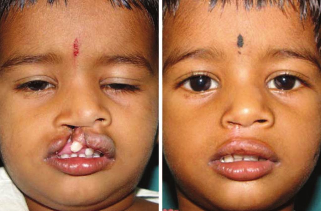 Volume 125, Number 4 Repair of Complete Unilateral Cleft Lip Fig. 3. Preoperative and postoperative frontal views of repair performed with Pfeifer incision, with a good score on all parameters.