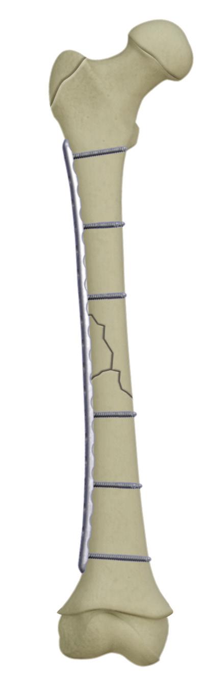 Product Overview The PediLoc Bowed Femur Plate was designed to adhere to the principles of internal fixation: Anatomic Reduction The Bowed Femur Plate is contoured to fit the femur of a child, aiding