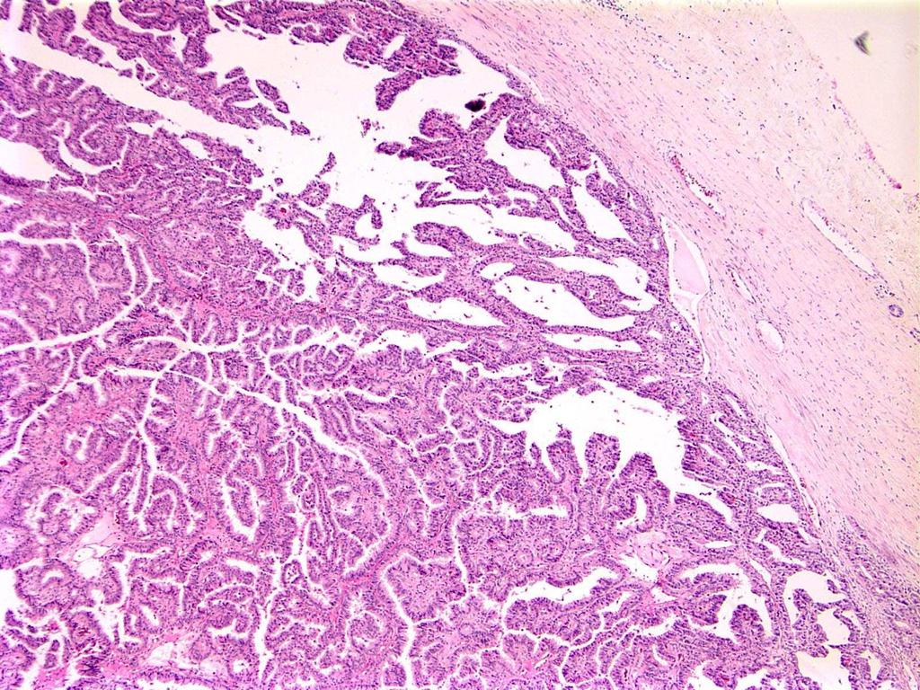 Circumscribed Nodule of Papillary Carcinoma No MEC
