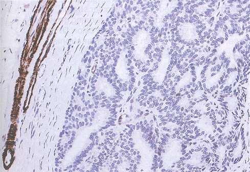 Solid Papillary Carcinoma: No MEC SMA Rosen