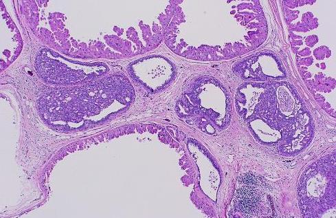 B-Multiple (microscopic) papillomas Peripheral multiple papillomas (TDLU), not mass forming.