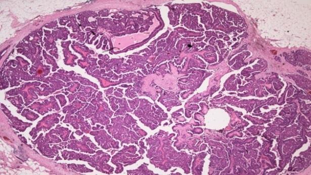 Classification 2- Presence of cytonuclear and architectural atypia Benign papilloma Papillary carcinoma (PC)
