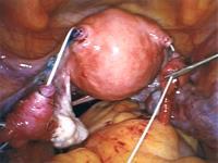 Tubal Surgery: Sterilisation Reversal No RCT comparing IVF with tubal reanastomosis Laparoscopic tubal reanastomosis Prospective cohort, Bissonnette et al 1999 Intrauterine pregnancy rate 65.