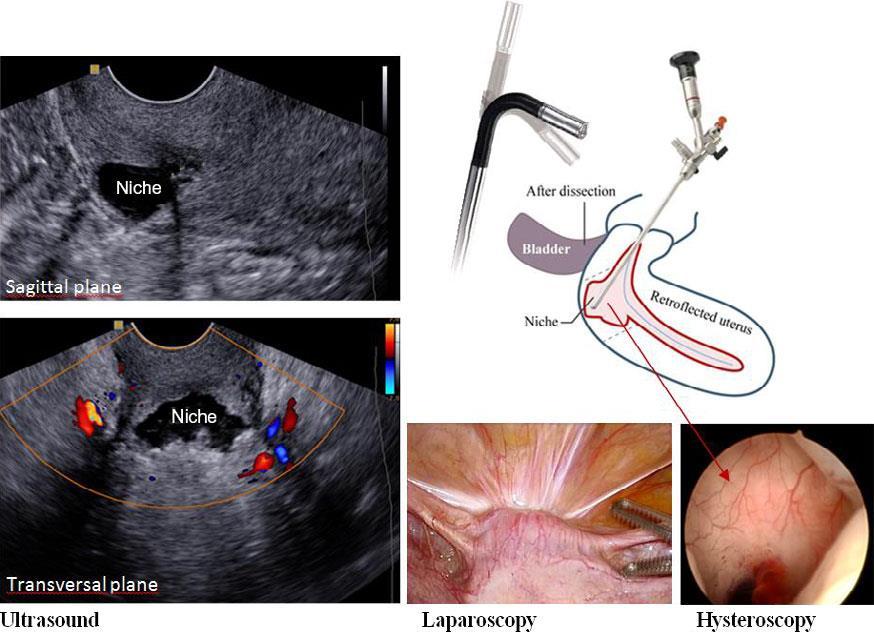 Caesarean Scar Niche (Isthmocoele) Becoming increasingly common Associated with: Secondary infertility Post menstrual spotting Dysmenorrhea and chronic pelvic pain