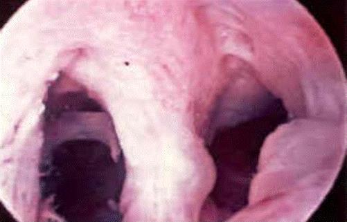 Hysteroscopic Metroplasty Many observational studies suggest an improved fecundity rate in subfertile women self-control design Many believe it is not reasonable to perform a RCT of treatment vs