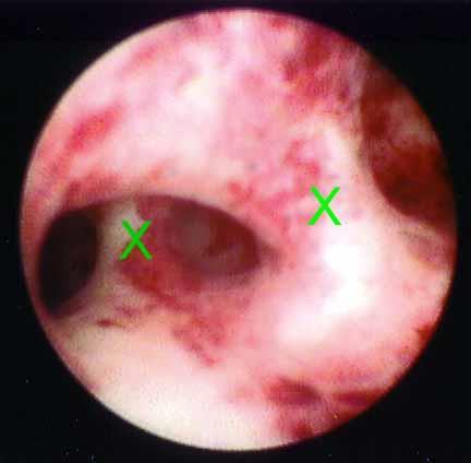 Hysteroscopic Synechiolysis No RCT or controlled trials Many poor quality non-controlled studies Difficult to compare results Use different, non-validated classification of disease severity