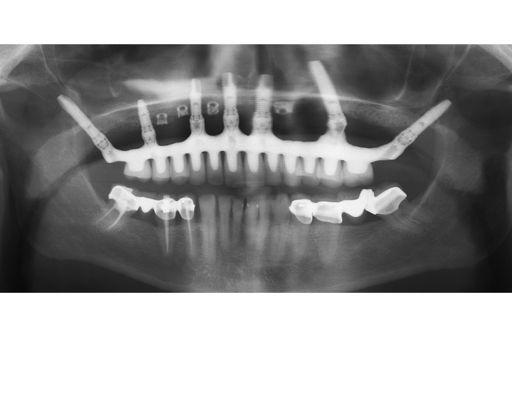 Post treatment radiographs of new osseointegrated Branemark Implants