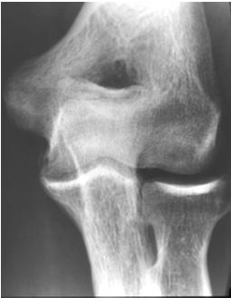 Osteochondritis of the Elbow When to treat How to treat When can pt return to sport