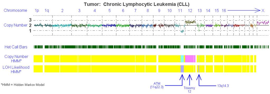 Chronic Lymphocytic Leukemia Five main genetic aberrations are recognized in CLL with major impact on disease behavior. From Gerson and Keagle, The Principles of Clinical Cytogenetics, 2 nd Ed, 2005.