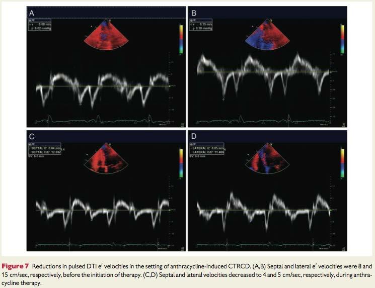 Myocardial strain is an early marker of cardiotoxicity